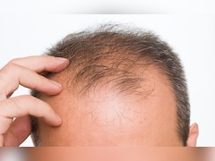 गंजे सिर पर भी उगने लगेंगे नए बाल बस एक बार अपनाएं ये देसी नुस्खा, जानिए क्या खाएं और कैसे करें इस्तेमाल Recipe