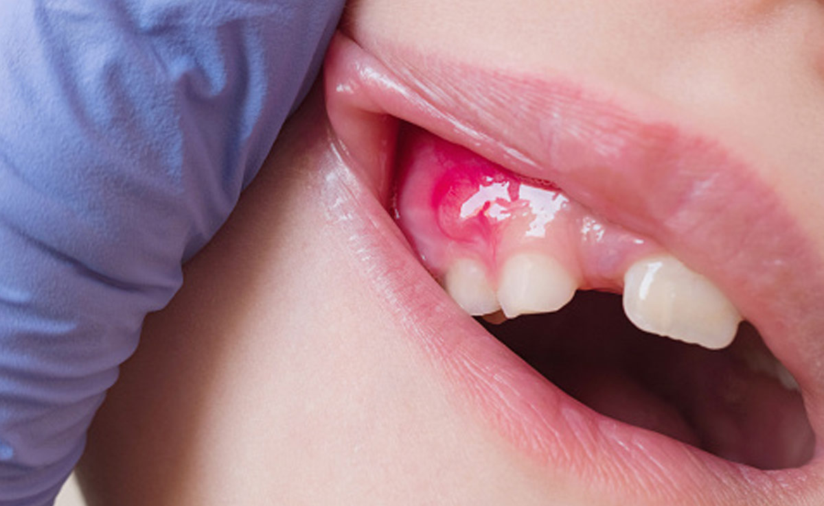 दांतों- मसूड़ों से पस या मवाद आए तो क्या करें? मुंह की सूजन से कैसे पाएं छुटकारा, क्या है इलाज