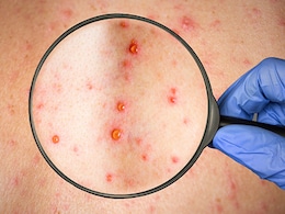 भारत के इस राज्य में बढ़े चिकनपॉक्स के मामले, बच्चे ही नहीं, बड़े भी हो रहे संक्रमित, जानिए किसे और क्यों होता है ये इंफेक्शन