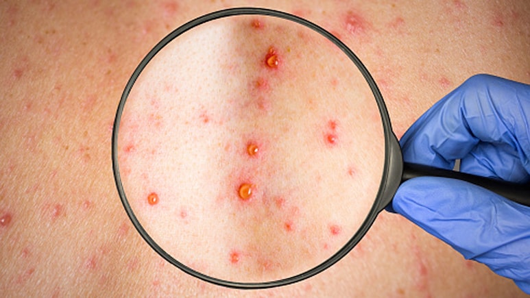 भारत के इस राज्य में बढ़े चिकनपॉक्स के मामले, बच्चे ही नहीं, बड़े भी हो रहे संक्रमित, जानिए किसे और क्यों होता है ये इंफेक्शन