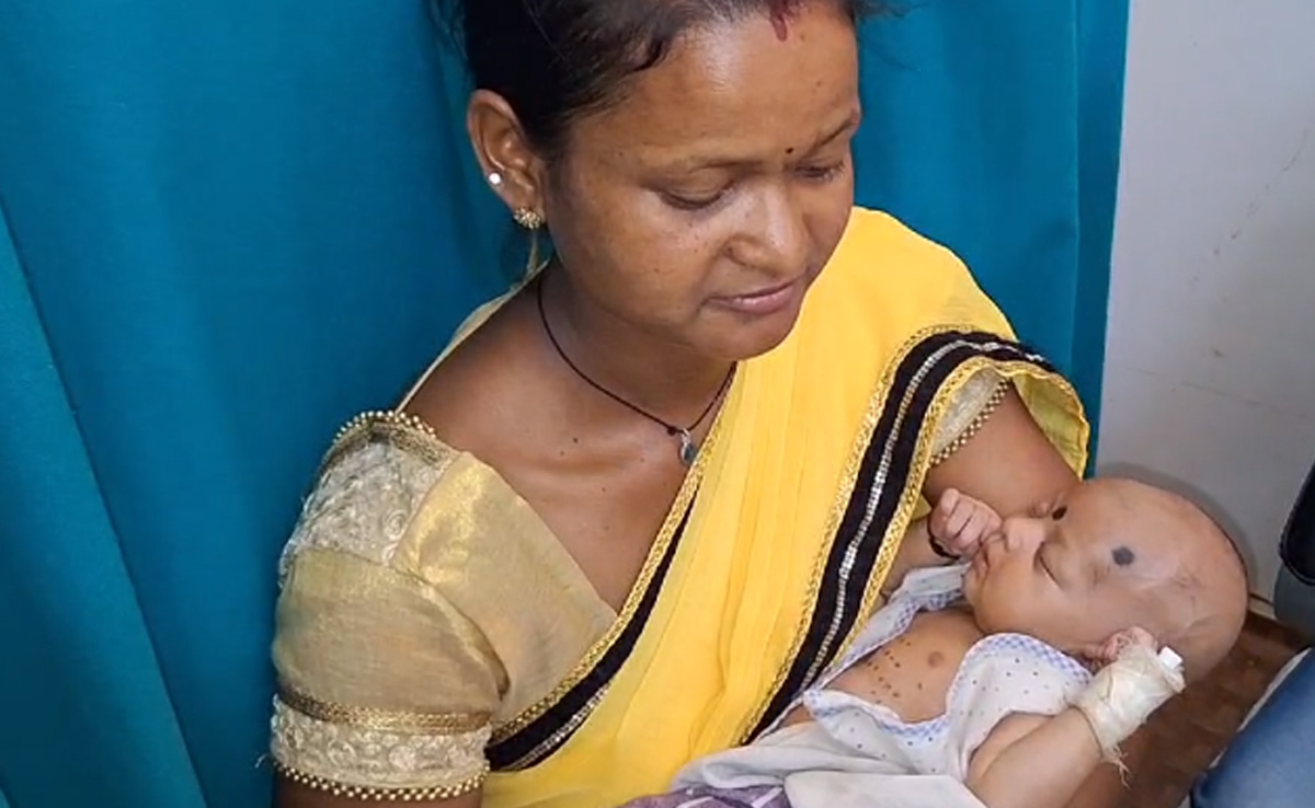 अंधविश्वास: जशपुर में 18 दिन बच्ची को गर्म लोहे से सैकड़ों जगह दागा, घायल अवस्था में अस्पताल में भर्ती