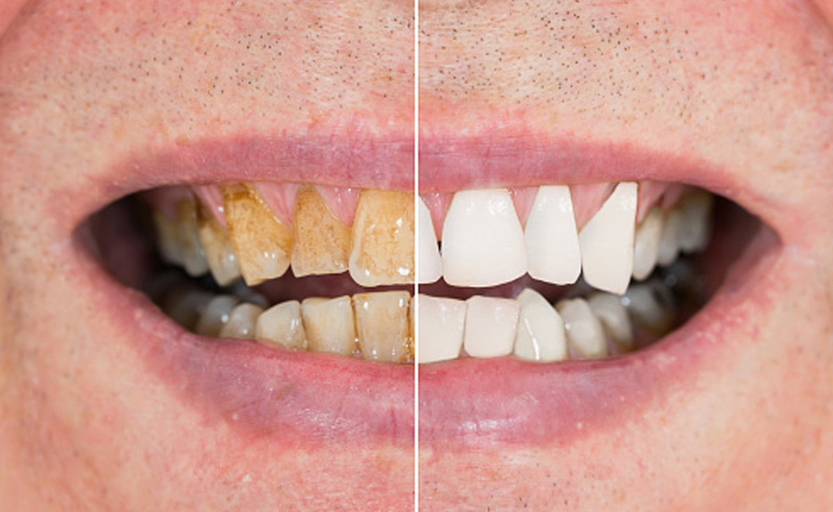 Gum Health Day 2024: Signs You Have Poor Gum Health