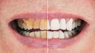 दांतों का पीलापन कैसे दूर करें, बस इन 4 घरेलू नुस्खों की मदद से मोतियों से चमकेंगे दांत!