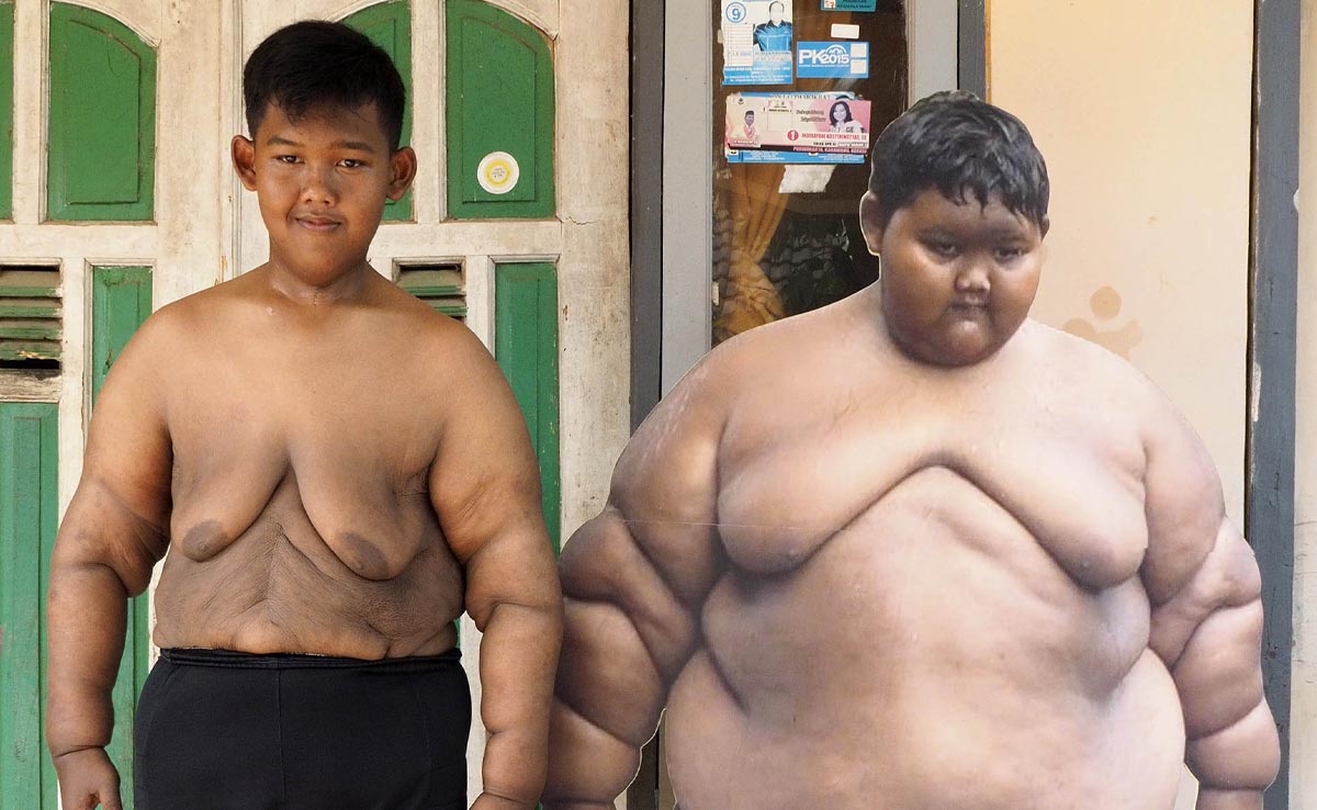 उम्र 10 साल, वजन 190 किलो, कैसे कम किया दुनिया के सबसे मोटे बच्चे ने 106 किलो वजन, जानें Weight-Loss Journey