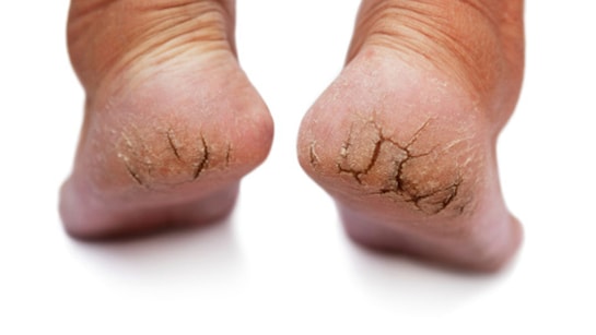 Cracked Heel: सर्दियों में भी चिकनी रहेंगी एड़ियां, इन पांच घरेलू तरीकों से फटी एड़ियों से मिलेगा छुटकारा