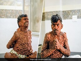 स्क्रीन पर भी बार-बार आती है ये तस्वीर? मदद मांग रहे इस शख्स को है नर्वस सिस्टम से जुड़ी बीमारी, जानें क्या है न्यूरोफाइब्रोमैटोसिस, कारण और लक्षण स्क्रीन पर भी बार-बार आती है ये तस्वीर? मदद मांग रहे इस शख्स को है नर्वस सिस्टम से जुड़ी बीमारी, जानें क्या है न्यूरोफाइब्रोमैटोसिस, कारण और लक्षण