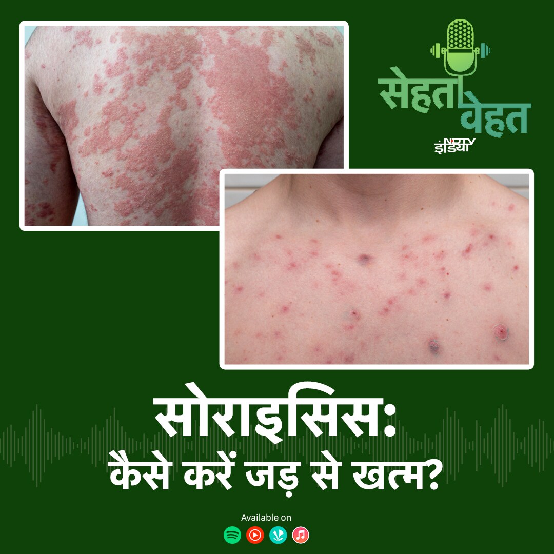 सोराइसिस, कैसे करें जड़ से खत्म? episode artwork