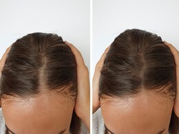 महीनों से बाल एक इंच भी नहीं बढ़ रहे हैं तो बायोटीन युक्त ये चीजें खाना कर दें शुरू, उगने लगेंगे नए हेयर महीनों से बाल एक इंच भी नहीं बढ़ रहे हैं तो बायोटीन युक्त ये चीजें खाना कर दें शुरू, उगने लगेंगे नए हेयर