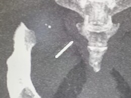 महिला के कूल्हे में 3 साल से फंसी थी आधी टूटी Needle, डॉक्टरों ने ऑपरेशन कर निकाली सुई महिला के कूल्हे में 3 साल से फंसी थी आधी टूटी Needle, डॉक्टरों ने ऑपरेशन कर निकाली सुई