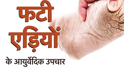 गर्मियों में भी फटने लगी हैं एड़ियां, तो जानिए इसका कारण और घरेलू उपचार