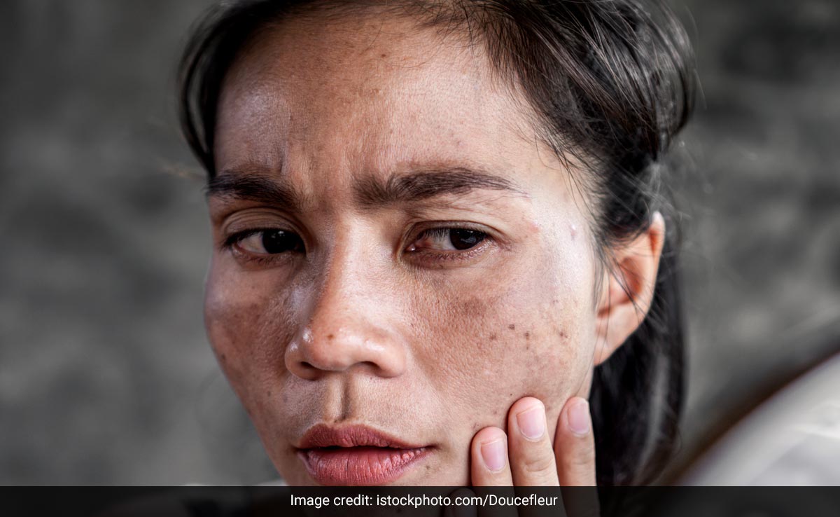क्यों काला पड़ने लगा है आपका चेहरा? क्यों होती है Skin Discoloration, जानें कारण और इलाज