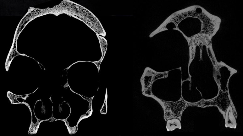 Cut Marks On 4,000-Year-Old Skulls Show Egyptians Tried To Treat Cancer