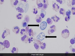 All About Naegleria Fowleri, Brain-Eating Amoeba That Killed Kerala Girl All About Naegleria Fowleri, Brain-Eating Amoeba That Killed Kerala Girl