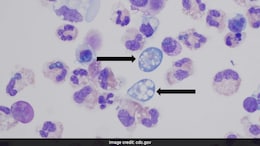 US Woman Dies From Brain-Eating Amoeba After Using Tap Water For Nasal Rinse