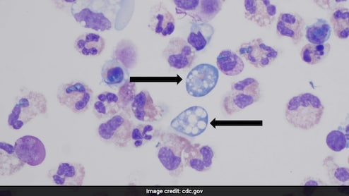 The Drug That's Being Used To Combat 'Brain-Eating Amoeba' In Kerala