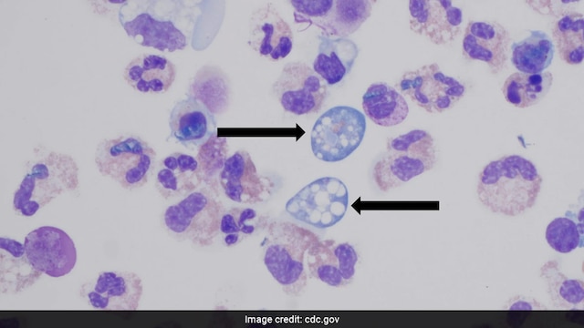 Surge In Deadly Brain-Eating Amoeba Cases In Kerala: Why And How It Spreads