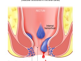 पाइल्स, फिशर और फिस्टुला में क्या हैं अंतर? जानिए क्या होते हैं इनके लक्षण, कारण और इलाज पाइल्स, फिशर और फिस्टुला में क्या हैं अंतर? जानिए क्या होते हैं इनके लक्षण, कारण और इलाज