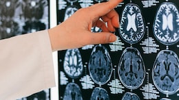 Scientists On Alert As Illness With Rapid Dementia Symptoms Emerges