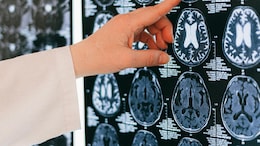 Is A Brain Network Linked To Stuttering? What Research Found