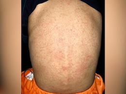 बच्चों को घमौरियों से बचाना चाहते हैं तो इन नुस्खों को जान लीजिए आज भी, हाथ-पैर खुजाते नहीं रहेंगे बच्चे बच्चों को घमौरियों से बचाना चाहते हैं तो इन नुस्खों को जान लीजिए आज भी, हाथ-पैर खुजाते नहीं रहेंगे बच्चे