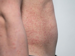 चिलिचिलाती गर्मी के कारण हो गई हैं घमौरियां तो यहां बताए घरेलू नुस्खे देंगे राहत, बार-बार खुजाने की नहीं पड़ेगी जरूरत  चिलिचिलाती गर्मी के कारण हो गई हैं घमौरियां तो यहां बताए घरेलू नुस्खे देंगे राहत, बार-बार खुजाने की नहीं पड़ेगी जरूरत