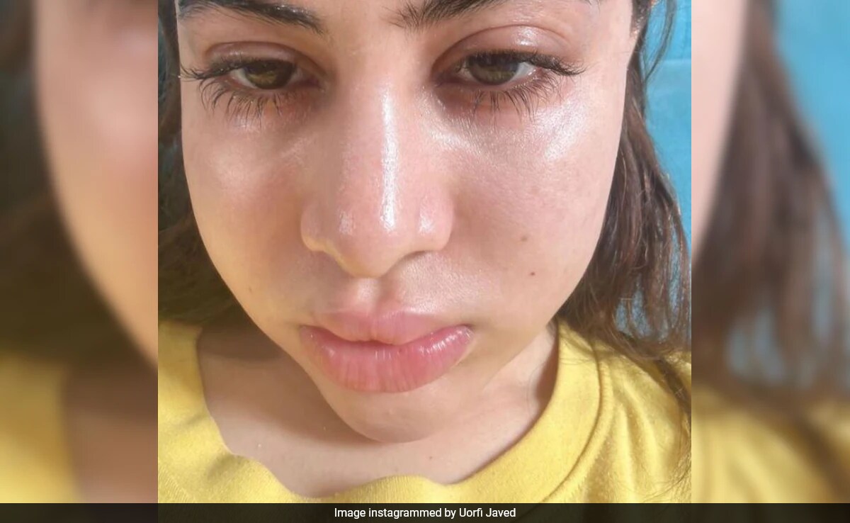 The Reason Behind Uorfi Javed's Swollen Face: "Fillers <i>Nahi Hai</i>,  Allergies <i>Hai</i>"