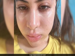 The Reason Behind Uorfi Javed's Swollen Face: "Fillers <i>Nahi Hai</i>,  Allergies <i>Hai</i>" The Reason Behind Uorfi Javed's Swollen Face: "Fillers <i>Nahi Hai</i>,  Allergies <i>Hai</i>"