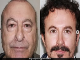 Before And After Pic Of Man After Facial Surgery In Turkey Leaves Internet In Disbelief Before And After Pic Of Man After Facial Surgery In Turkey Leaves Internet In Disbelief