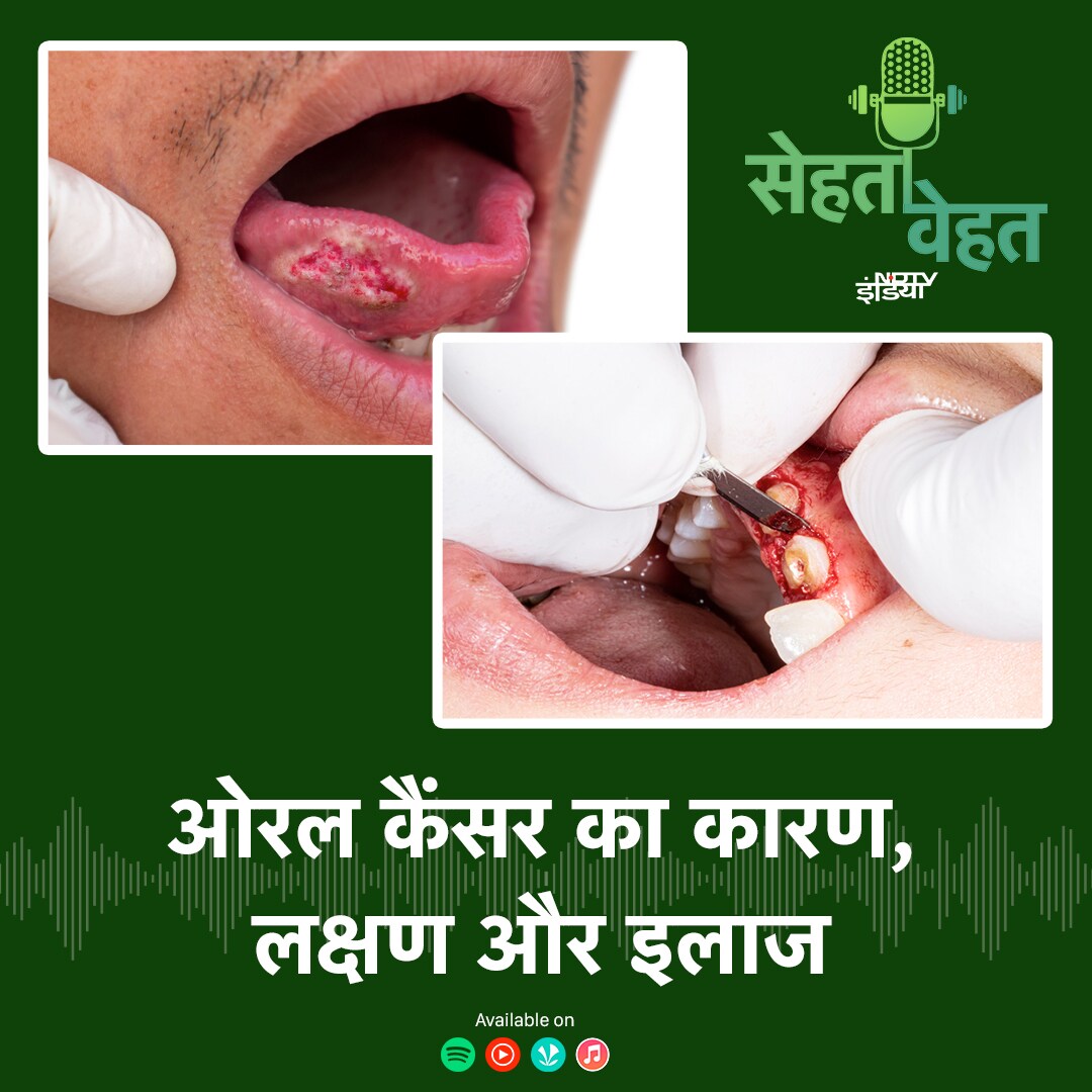 ओरल कैंसर का कारण, लक्षण और इलाज episode artwork