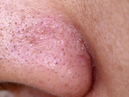 नाक या ठुड्डी पर नजर आने लगे हैं वाइटहेड्स तो इन 4 चीजों का इस्तेमाल दूर कर सकता है दिक्कत, मुलायम हो जाएगी त्वचा  नाक या ठुड्डी पर नजर आने लगे हैं वाइटहेड्स तो इन 4 चीजों का इस्तेमाल दूर कर सकता है दिक्कत, मुलायम हो जाएगी त्वचा