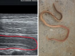 पेट दर्द से परेशान था युवक, जांच की तो आंत में नजर आया 30 सेमी लम्बा कीड़ा, डॉक्टर ने दी ये जरूरी सलाह पेट दर्द से परेशान था युवक, जांच की तो आंत में नजर आया 30 सेमी लम्बा कीड़ा, डॉक्टर ने दी ये जरूरी सलाह