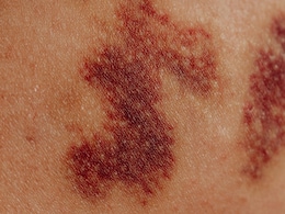 चोट लगने पर आप भी लगा लेते हैं मिट्टी का लेप, फिर तो ये खबर है आपके लिए है, जानिए ऐसा करने के नुकसान