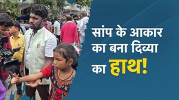 सांप के आकार का हाथ लेकर 12 साल की बच्ची ने लगाई मदद की गुहार, CM साय ने 1.5 लाख रुपये किए जारी