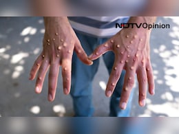 Opinion | Is India Really At Risk Of A Monkeypox Outbreak? Opinion | Is India Really At Risk Of A Monkeypox Outbreak?