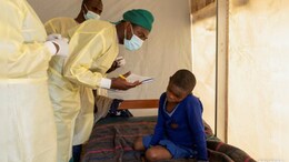 Mpox Virus Killed 548 People In This Nation Since Start Of 2024