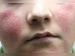 Human Parvovirus B19 On The Rise In US, CDC Warns Of 'Slapped Cheek' Virus Human Parvovirus B19 On The Rise In US, CDC Warns Of 'Slapped Cheek' Virus