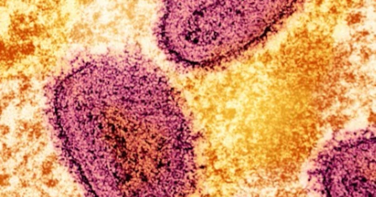 Difference Between Monkeypox And Chickenpox difference-between-monkeypox-and-chickenpox