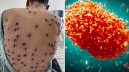 New Mpox Strain Mutating Very Rapidly. How Scientists Are Responding