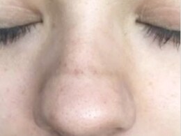 अगर आपकी नाक के ऊपर भी दिखने लगी है लकीर तो छोड़ दें यह एक काम, डर्मेटोलॉजिस्ट ने दी सलाह 