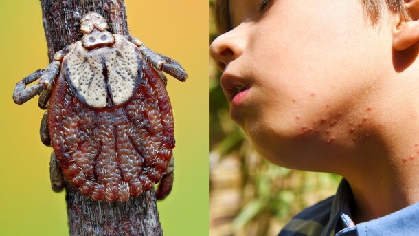 Scrub Typhus: बच्चों को पार्क में खेलने के लिए भेजते हैं तो हो जाएं सावधान, एक कीड़े के काटने से हो सकता है ये जानलेवा संक्रमण