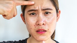 Psoriasis VS. Eczema: Understanding The Differences And Natural Treatments