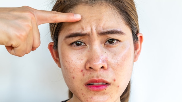 Psoriasis VS. Eczema: Understanding The Differences And Natural Treatments