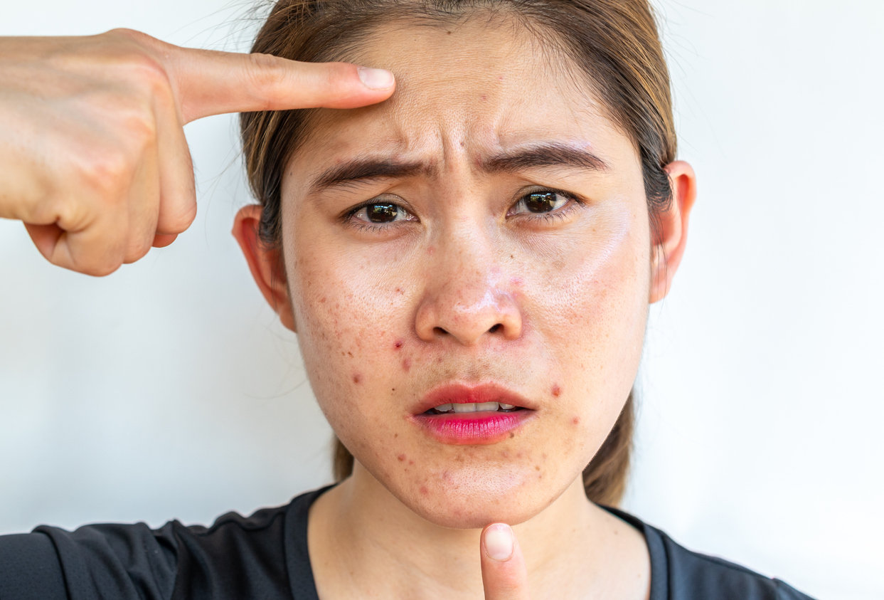 Psoriasis VS. Eczema: Understanding The Differences And Natural Treatments