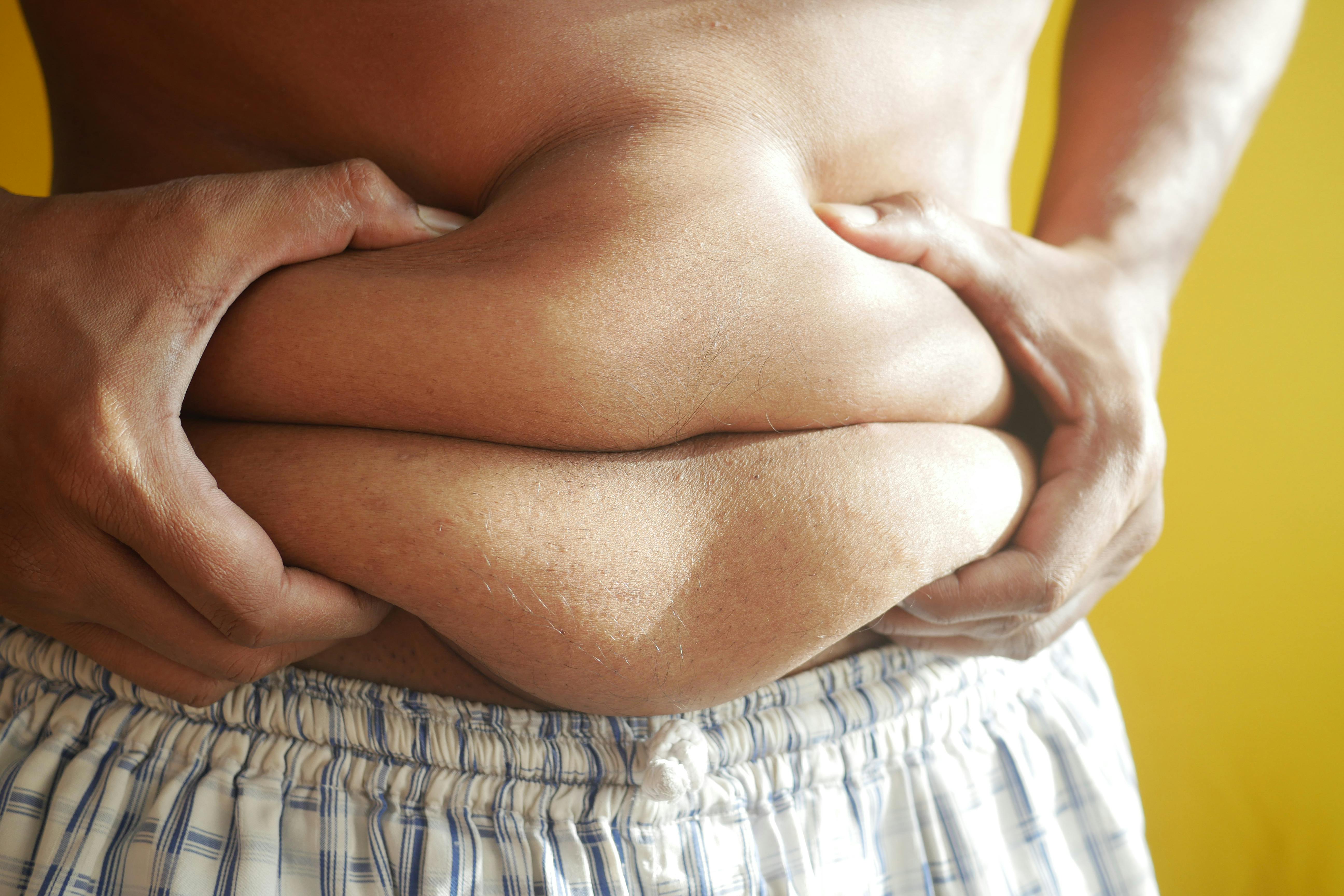Obesity Raises Risk Of Hospitalisation, Death From Infections By 70%: Study