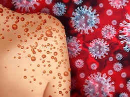 US CDC रिपोर्ट में सामने आई Mpox जुड़ी ये बड़ी बात, अफ्रीका के बाद स्वीडन, थाईलैंड में भी फैला