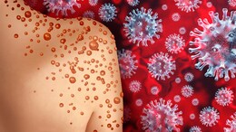 Mpox Virus:&nbsp;कोविड की तरह लॉकडाउन करवा सकता है मंकीपॉक्स वायरस? क्या कहते हैं एक्सपर्ट