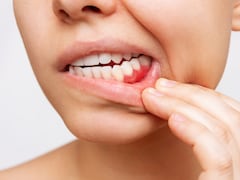 Periodontal Diseases: How Sugar Affects Your Dental Health