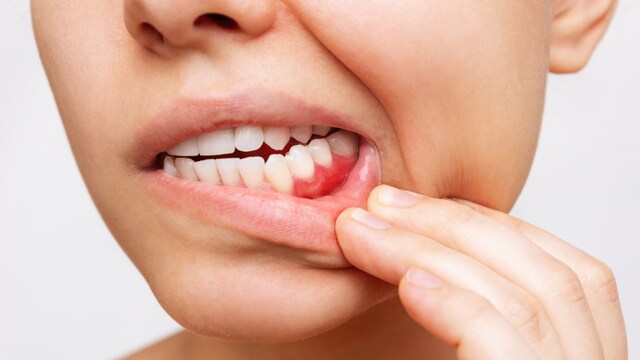 Sugar serves as a food source for the bacteria in your mouth