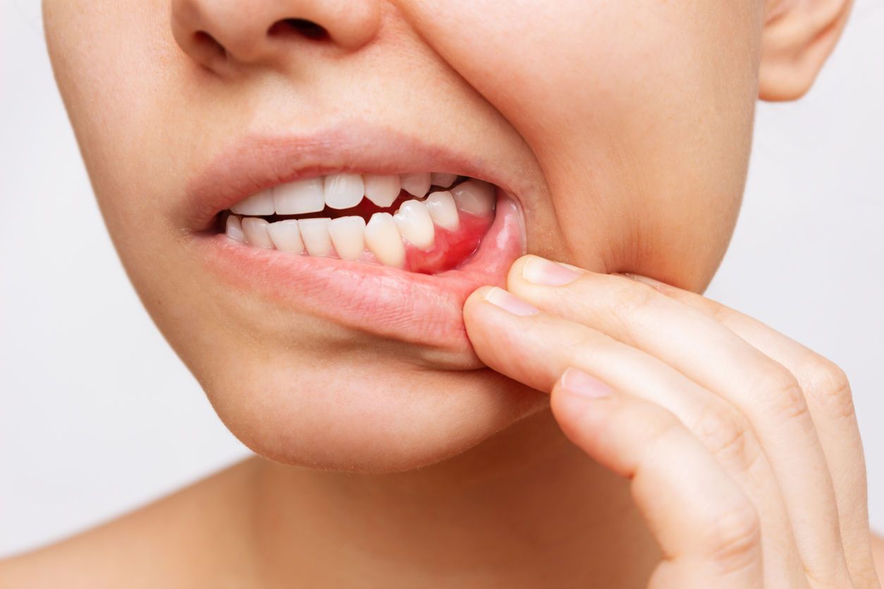 Sugar serves as a food source for the bacteria in your mouth
