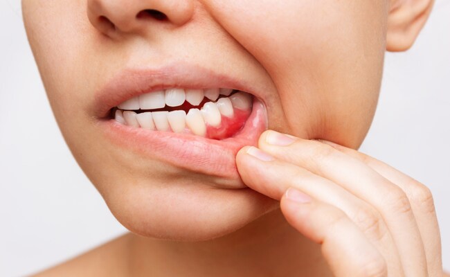Periodontal Diseases: How Sugar Affects Your Dental Health Periodontal Diseases: How Sugar Affects Your Dental Health